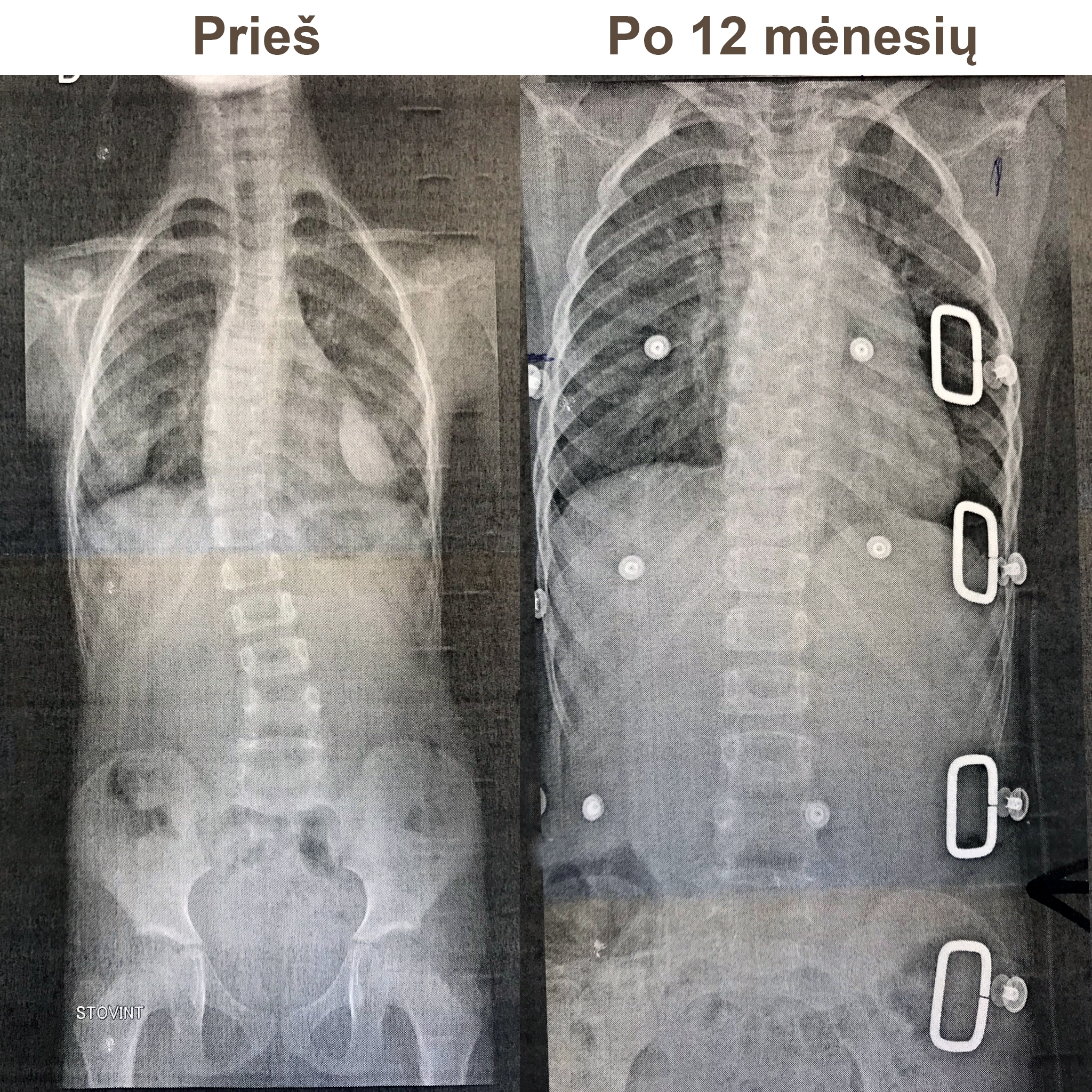 Korseto dėvėjimas prieš ir po 12 mėn.