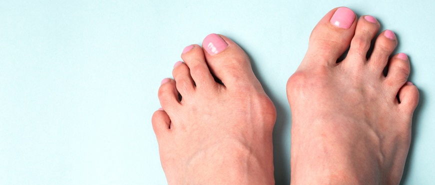 Hallux valgus