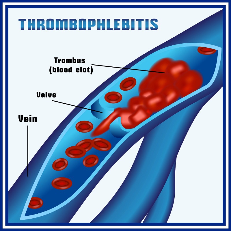 Tromboflebitas